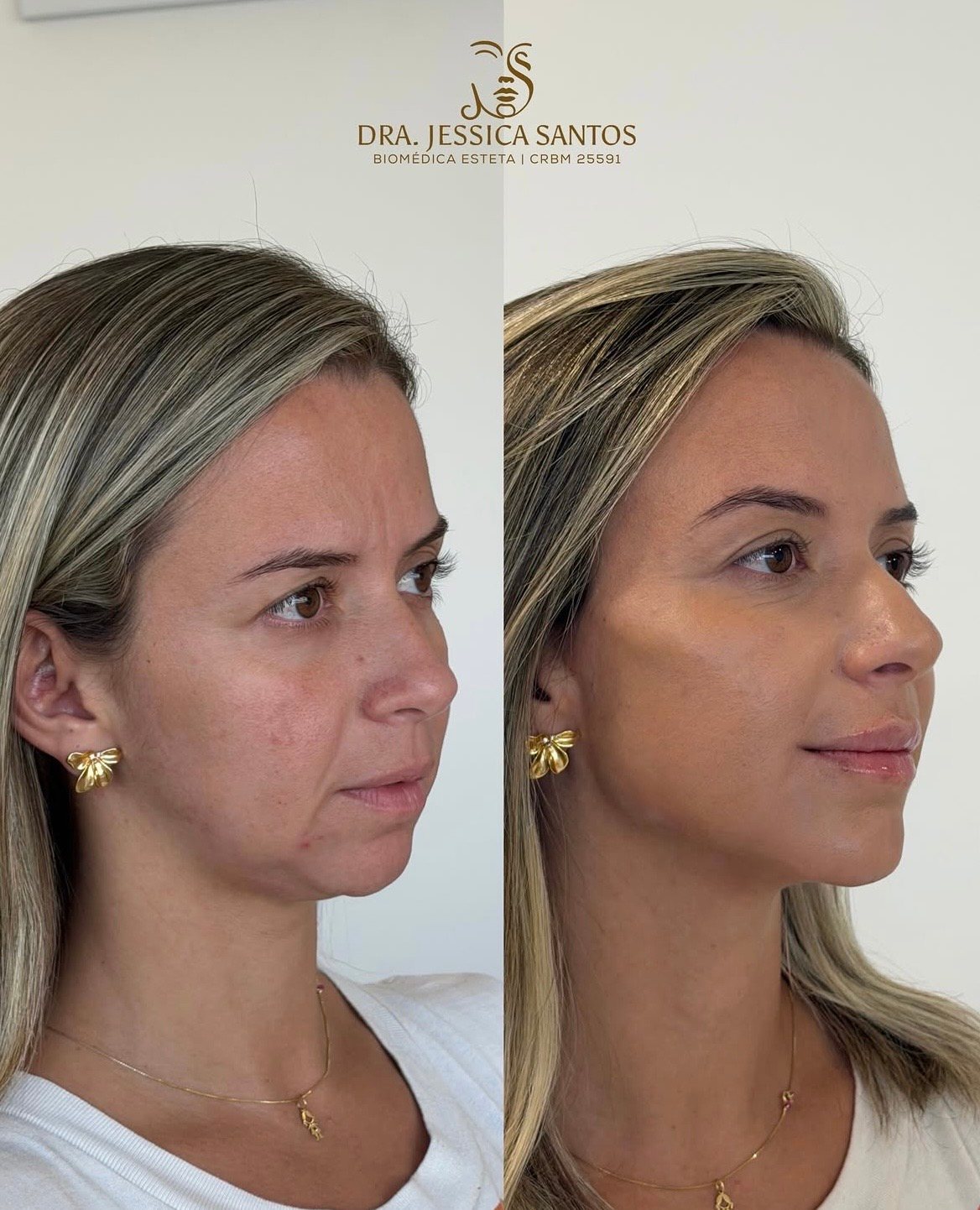 Resultado de harmonização facial 1 — antes e depois
