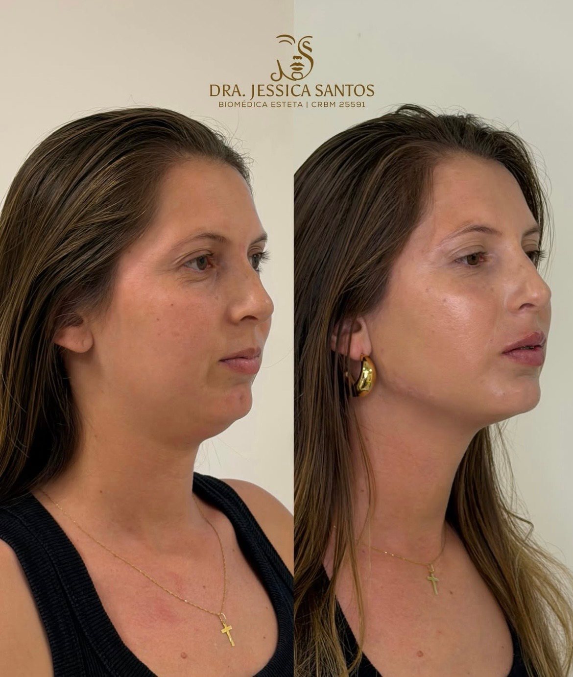 Resultado de harmonização facial 2 — antes e depois