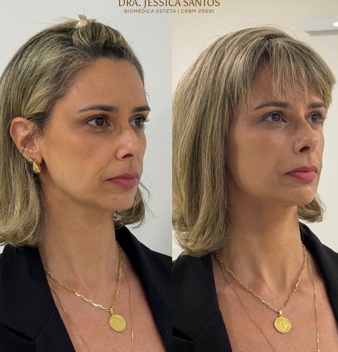 Resultado de harmonização facial 3 — antes e depois