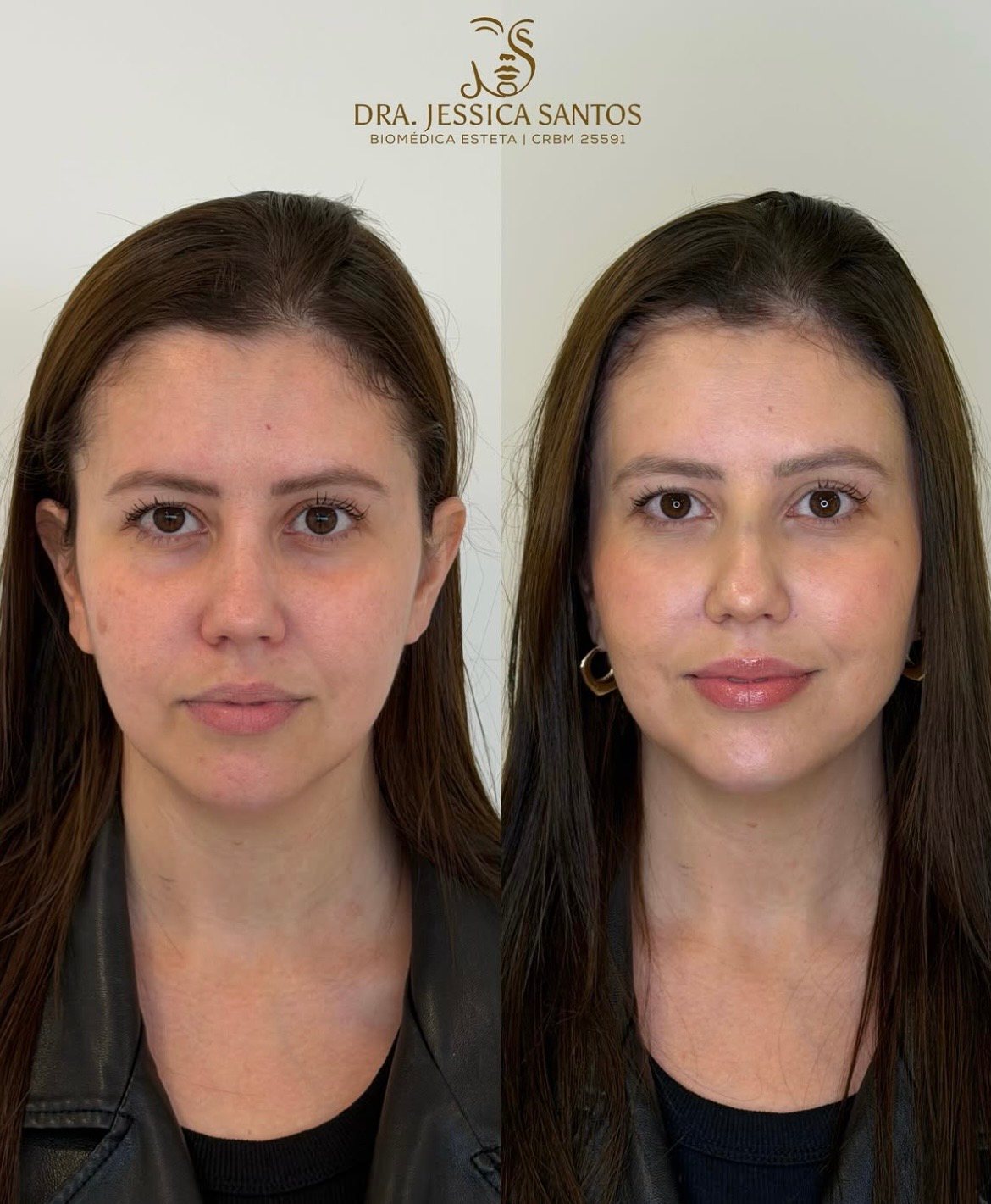 Resultado de harmonização facial 4 — antes e depois
