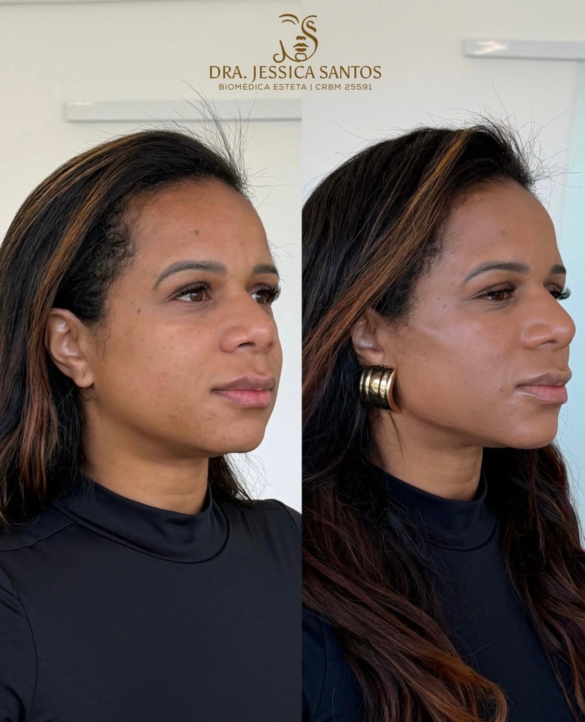 Resultado de harmonização facial 5 — antes e depois