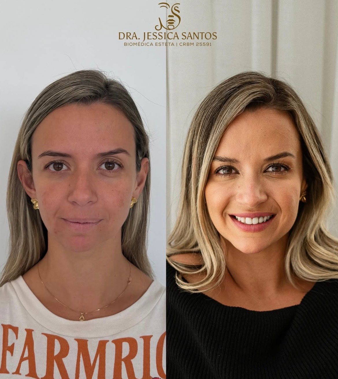 Resultado de harmonização facial 6 — antes e depois