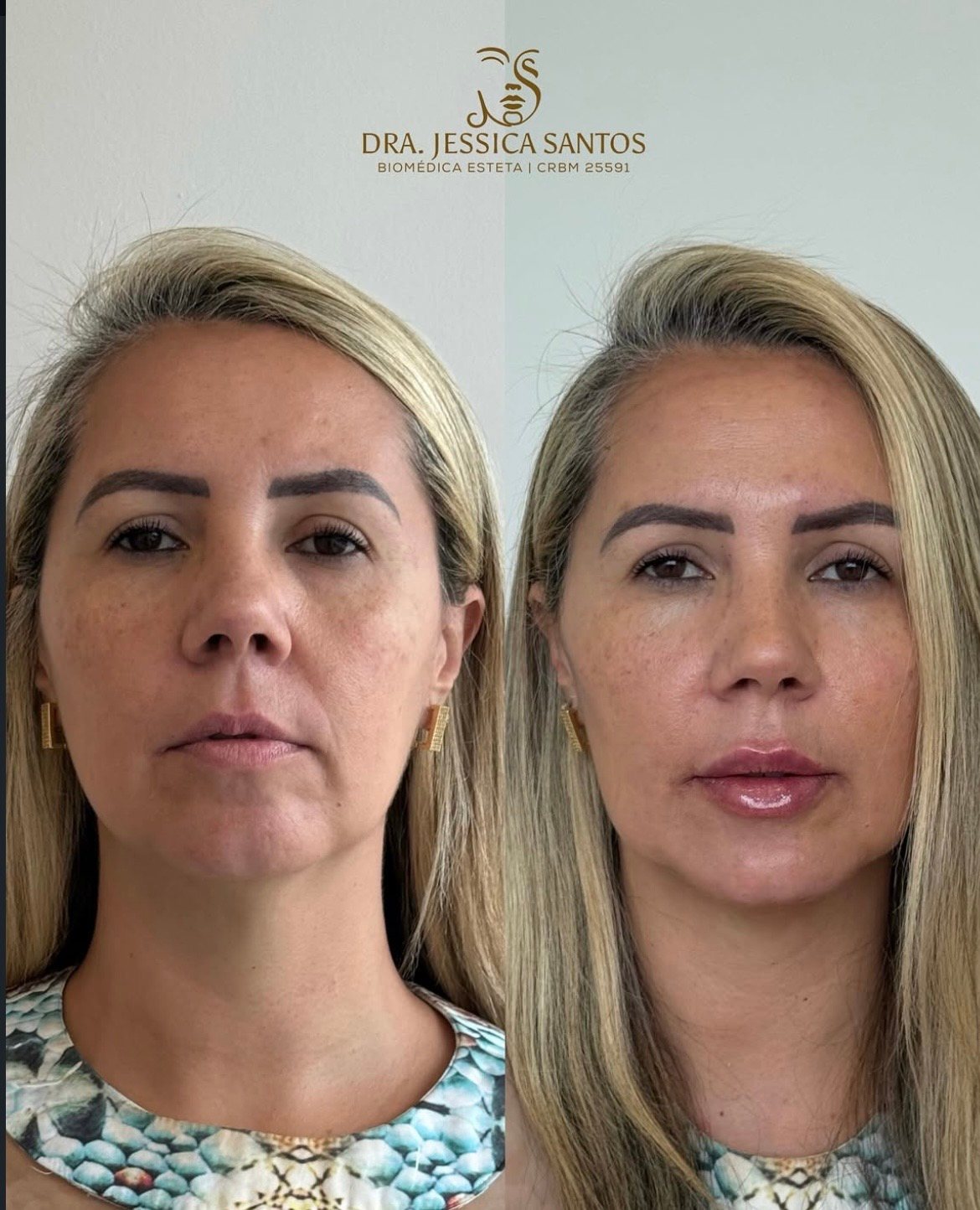Resultado de harmonização facial 7 — antes e depois