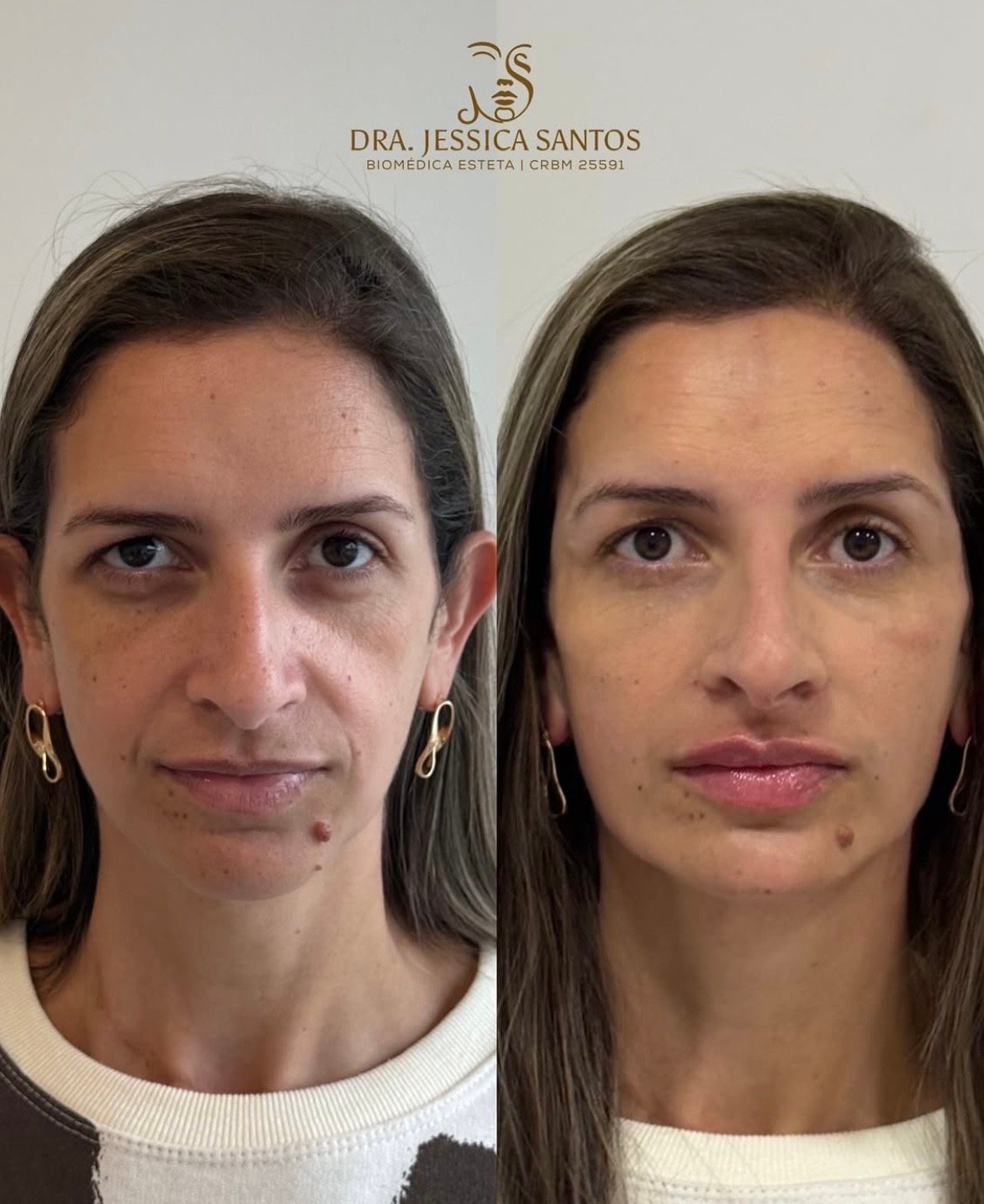 Resultado de harmonização facial 8 — antes e depois